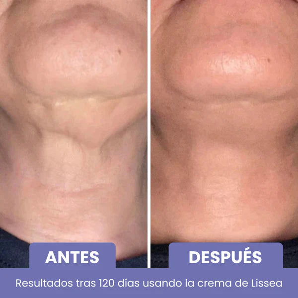 Élan™ – Cuello y escote más firmes, suaves y radiantes