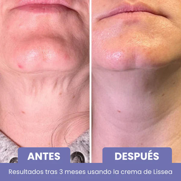 Élan™ – Cuello y escote más firmes, suaves y radiantes