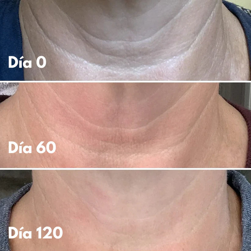 Élan™ – Cuello y escote más firmes, suaves y radiantes