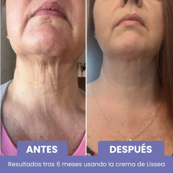 Élan™ – Cuello y escote más firmes, suaves y radiantes