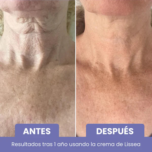 Élan™ – Cuello y escote más firmes, suaves y radiantes